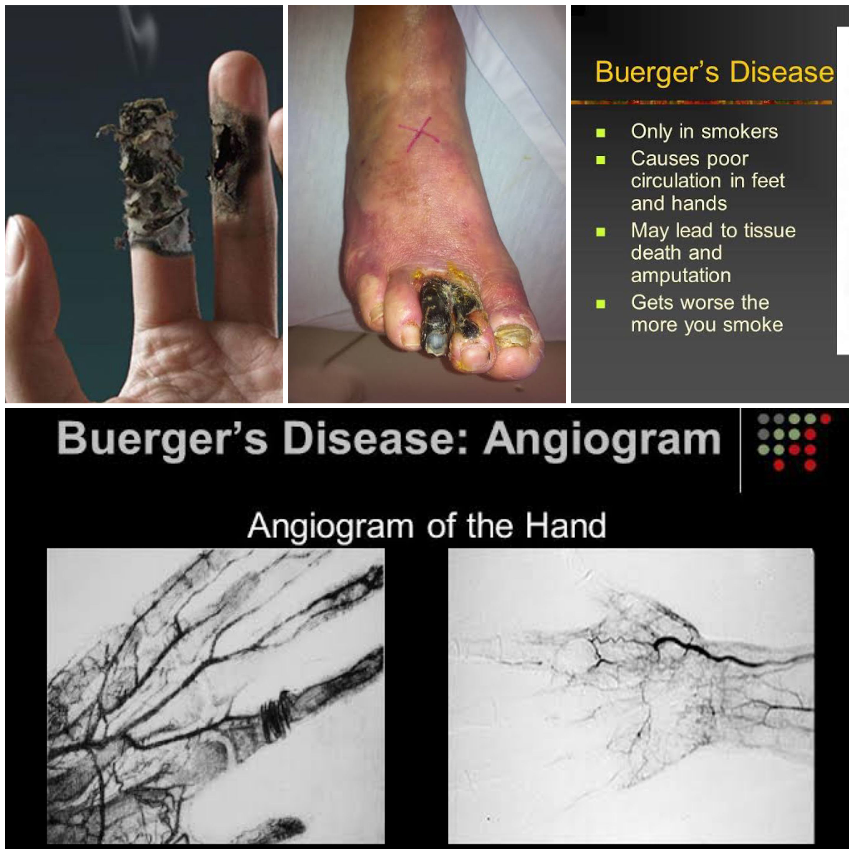 Buergers disease treatment.jpg